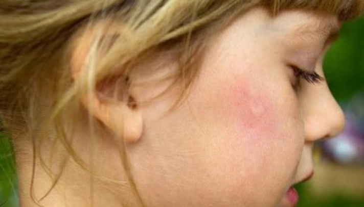 Οι ειδικοί συμβουλεύουν: Tips για να μην τσιμπήσει το παιδί σου κουνούπι