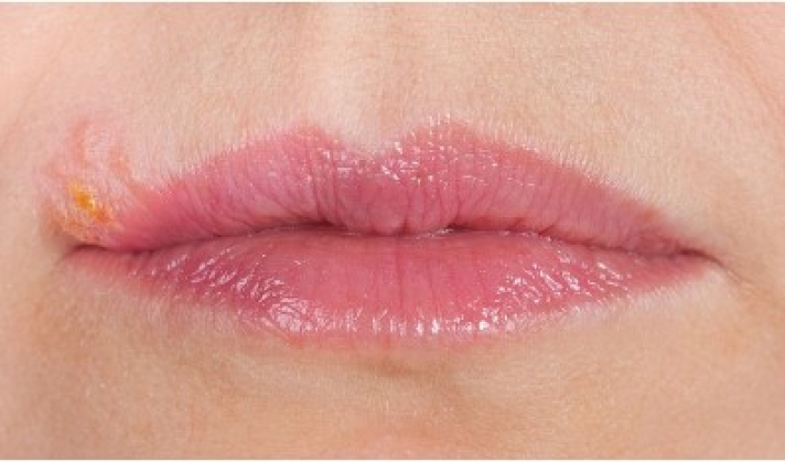 Λειχήνας στόματος: Ανακουφιστείτε με το πιο απλό γιατροσόφι